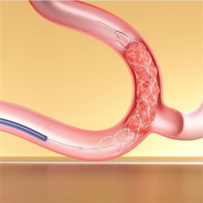 Stent Retriever česanie s aspiračným katétrom